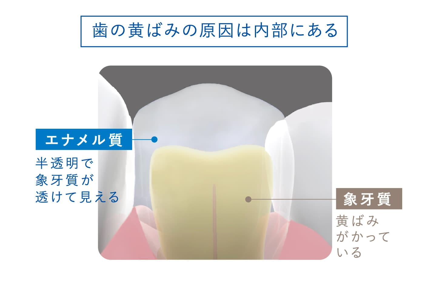 歯の黄ばみの原因は内部にある、エナメル質、半透明で象牙質が透けて見える、象牙質、黄ばみがかっている