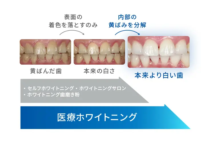 医療ホワイトニングなら本来より白い歯に