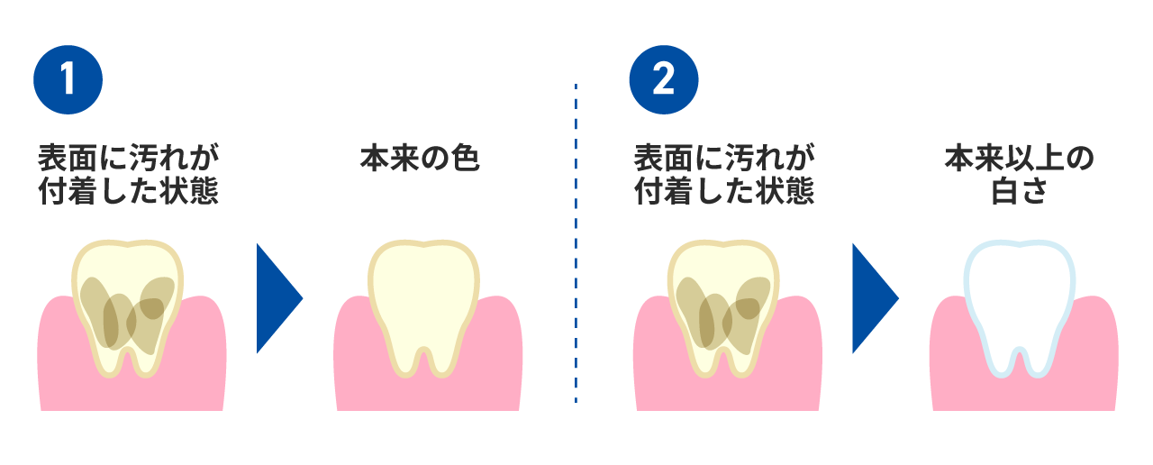 歯を白くする2つの方法